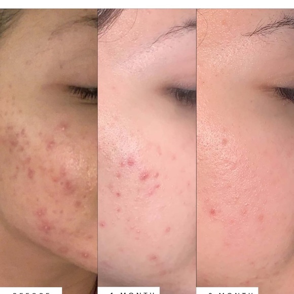 Herbivore Lapis Blue Tansy +Squalane Balancing Facial Oil - Picture 5 of 7